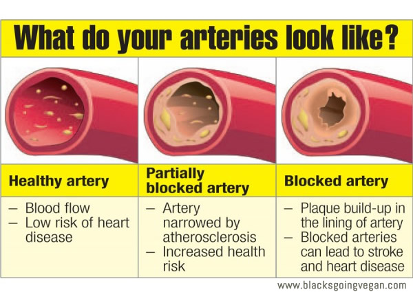 Artery Fat 90